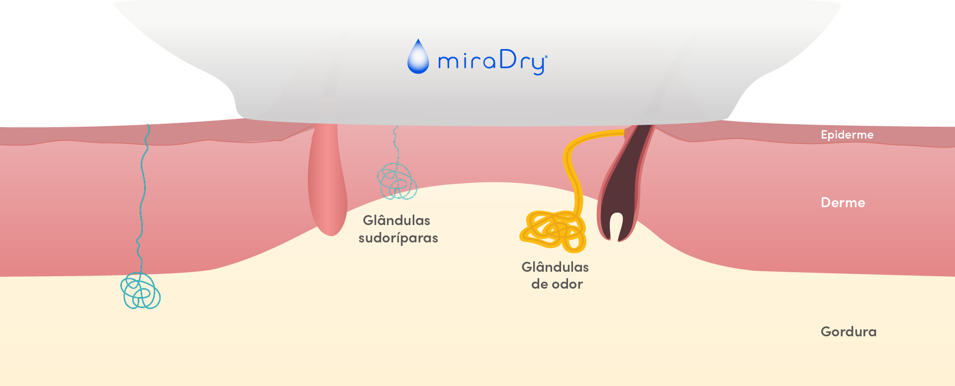 Como funciona o miraDry?