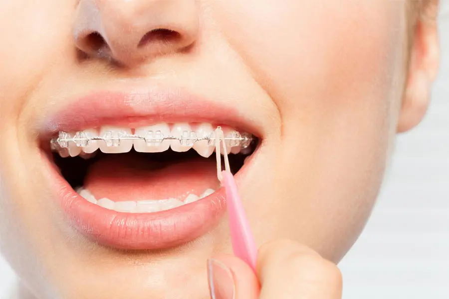 A imagem apresenta um close-up da boca de uma pessoa, destacando um alinhador dental transparente sendo colocado ou removido dos dentes. O dispositivo ortodôntico encaixa-se perfeitamente sobre os dentes, sugerindo seu uso para correção dentária de forma discreta e confortável, como alternativa aos aparelhos metálicos tradicionais.