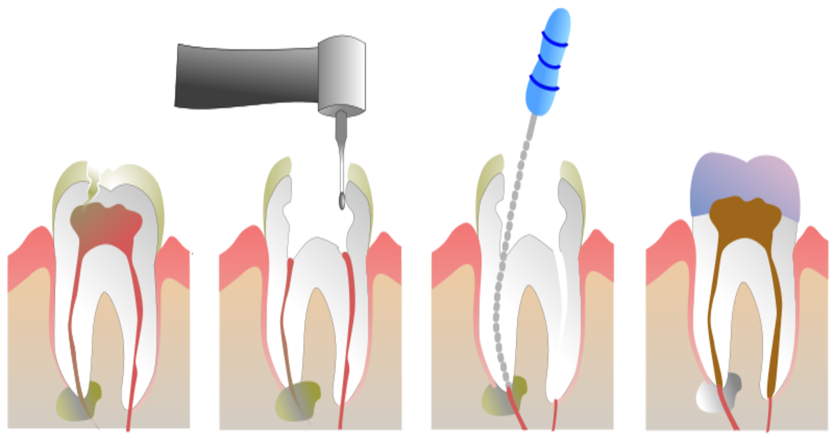 A ilustração apresenta um passo a passo do tratamento de canal dentário. O primeiro quadro mostra um dente com polpa infectada ou danificada. O segundo quadro representa a remoção da polpa comprometida com o uso de um instrumento odontológico. O terceiro quadro ilustra a limpeza e modelagem dos canais radiculares utilizando uma lima. O quarto quadro demonstra o preenchimento dos canais limpos com um material biocompatível e o selamento do dente com uma restauração ou coroa. A imagem é útil para entender as etapas envolvidas no tratamento de canal, um procedimento comum na odontologia para salvar dentes comprometidos por cáries ou infecções.