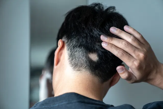 A imagem mostra a parte de trás da cabeça de uma pessoa com uma mão tocando os cabelos. Há uma área visível de perda capilar na região inferior, sugerindo um quadro de alopecia areata ou outra condição relacionada à queda de cabelo localizada.