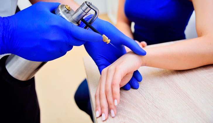 A imagem mostra um procedimento de crioterapia sendo realizado no antebraço de uma pessoa. Um profissional, vestindo luvas azuis, segura um dispositivo metálico com um pequeno bico aplicador. O equipamento libera um agente de resfriamento sobre a pele, um método comum utilizado para tratar verrugas, lesões cutâneas e outras condições dermatológicas por meio de congelamento controlado.
