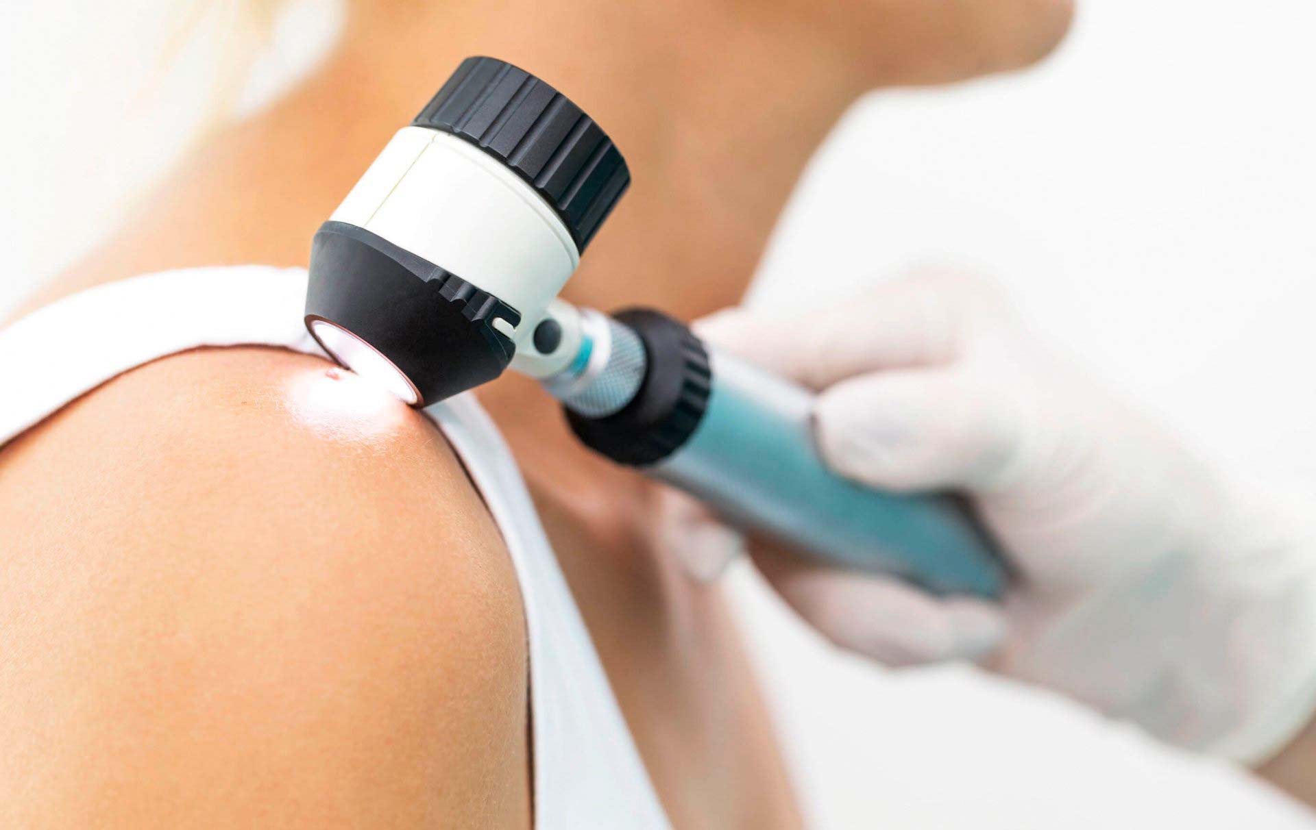 A imagem mostra um profissional de saúde examinando uma lesão cutânea no ombro de uma pessoa usando um dermatoscópio. O indivíduo veste uma regata branca, enquanto o especialista utiliza luvas brancas para o procedimento. O dermatoscópio é um dispositivo portátil com fonte de luz e lente de aumento, empregado para analisar sinais de câncer de pele ou outras condições dermatológicas. A cena destaca a importância da inspeção regular da pele e o uso de ferramentas especializadas para diagnóstico precoce.