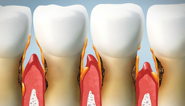 A imagem mostra um corte transversal de quatro dentes e seus tecidos gengivais ao redor. As gengivas são representadas em vermelho, ilustrando diferentes estágios de doenças periodontais. Conforme a condição avança, observa-se a retração gengival, expondo mais das raízes dentárias. Também há evidências de acúmulo de tártaro ou placa ao longo da linha da gengiva e raízes dos dentes, ressaltando a importância da higiene bucal para evitar recessão gengival e perda dentária.