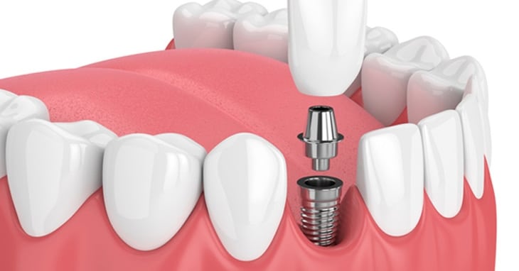 A imagem apresenta um procedimento de implante dentário em um corte transversal da gengiva e dos dentes. O implante consiste em um parafuso metálico inserido no osso da mandíbula, um conector (abutment) fixado ao parafuso e uma coroa dental posicionada sobre o abutment para simular um dente natural. A ilustração destaca as etapas envolvidas na cirurgia de implante dentário, um procedimento comum para substituir dentes perdidos.
