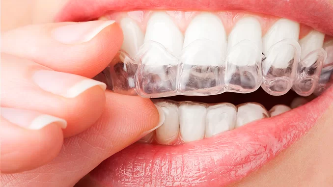 A imagem apresenta um close-up da boca de uma pessoa, destacando um alinhador dental transparente sendo colocado ou removido dos dentes. O dispositivo ortodôntico encaixa-se perfeitamente sobre os dentes, sugerindo seu uso para correção dentária de forma discreta e confortável, como alternativa aos aparelhos metálicos tradicionais.