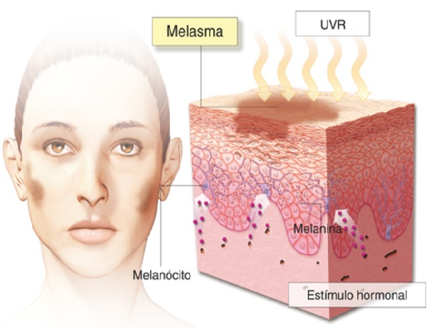 A ilustração apresenta um diagrama da pele com foco no melasma. Destacam-se as camadas cutâneas, a presença de melanina e os fatores que influenciam a hiperpigmentação, como radiação ultravioleta (UVR) e estímulos hormonais. Os elementos visuais e as legendas auxiliam na compreensão dos mecanismos por trás do melasma, uma condição dermatológica caracterizada por manchas escuras na pele.