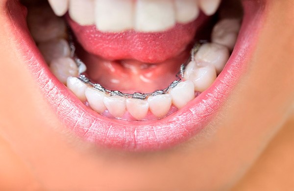 A imagem mostra um close-up da boca aberta, revelando os dentes e um aparelho ortodôntico lingual. Este tipo de aparelho é fixado na parte interna dos dentes, tornando-se menos visível externamente. A foto destaca uma opção de tratamento odontológico estética e discreta para alinhamento dentário.