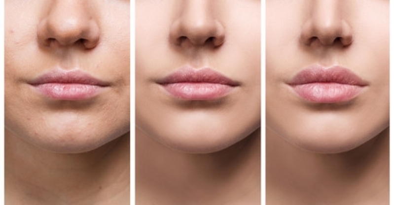A imagem exibe uma sequência de três comparações da pele facial. A primeira parte mostra a pele com pequenas imperfeições, como manchas e textura irregular. As duas partes seguintes aparecem desfocadas, sugerindo uma possível transformação ou tratamento dermatológico, embora os detalhes não estejam claramente visíveis.