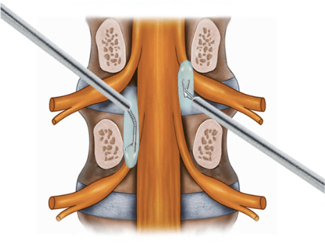 Ilustração médica mostrando um procedimento na coluna vertebral. A imagem detalha vértebras, discos intervertebrais e nervos espinhais, com instrumentos cirúrgicos inseridos dos lados esquerdo e direito, possivelmente para um procedimento de fusão ou descompressão da coluna. A ilustração é útil para compreender a anatomia e as técnicas utilizadas em cirurgias de coluna.